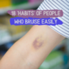 18 'Habits' of People Who Bruise Easily