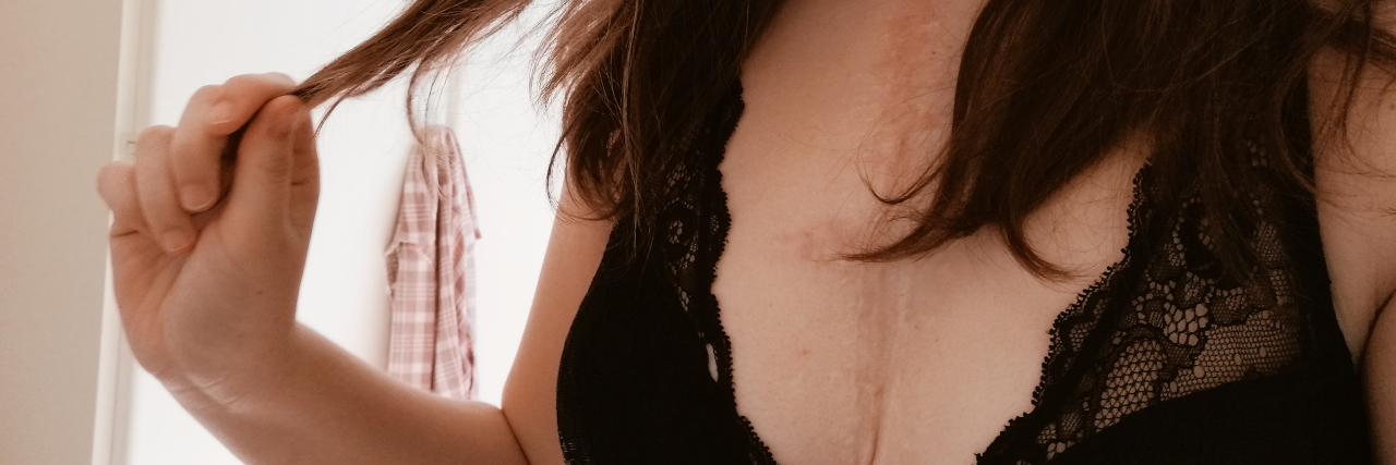 Embracing My Scars After Open Heart Surgery Bailey showing her scars.