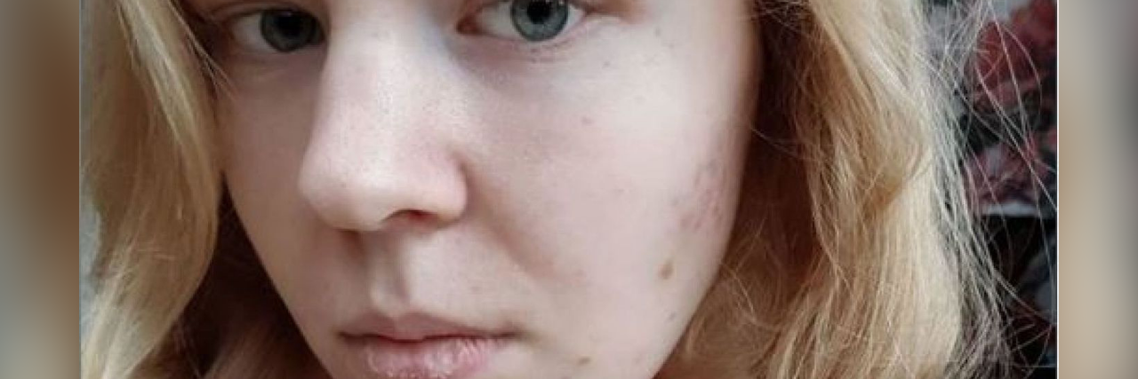 Noa Pothoven Did Not Die by Assisted Suicide After Mental Illness Noa Pothoven