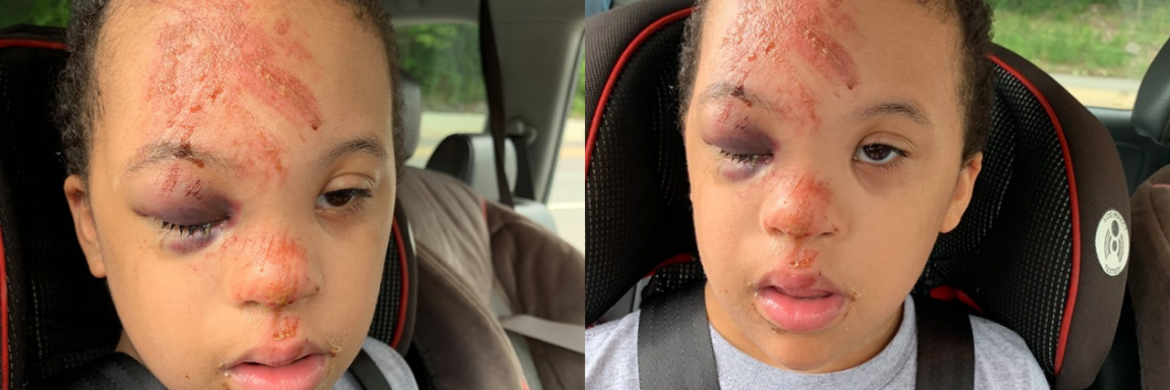 Boy With Down Syndrome Injured in Fall at School, Family Demands Video Michael Perrin, boy with Down syndrome, injured in fall at school