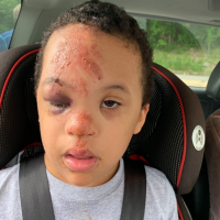 Michael Perrin, boy with Down syndrome, injured in fall at school