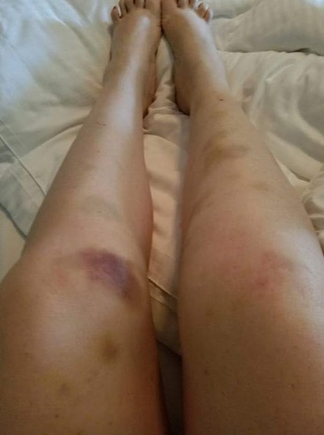 legs with bruises all over