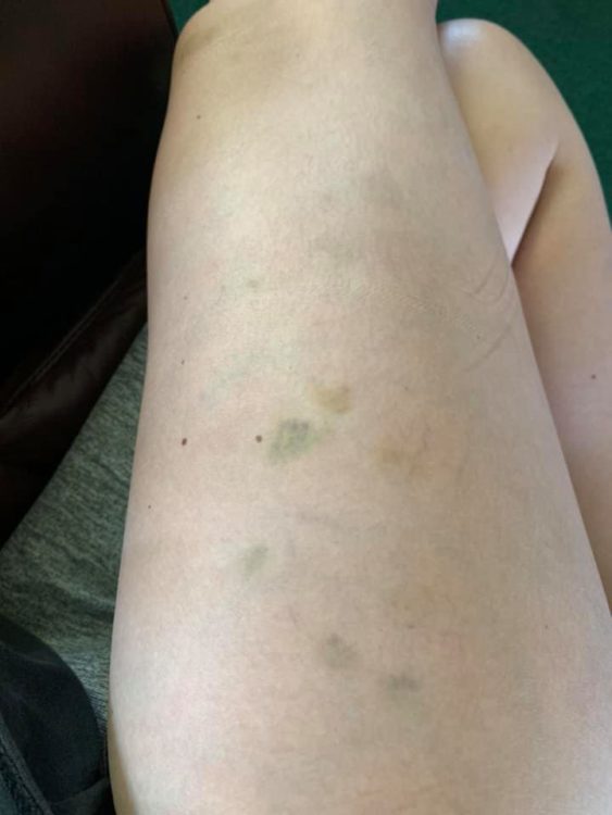 woman's leg with bruises on it