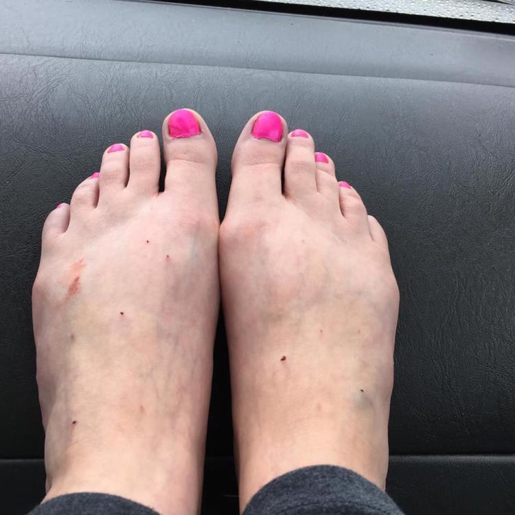 bruised feet and pink toenails
