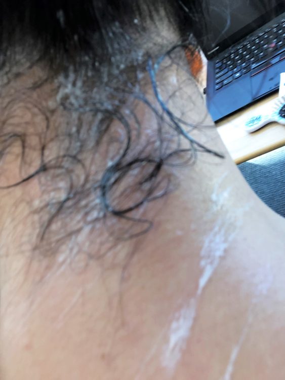 hair stuck to topical on neck