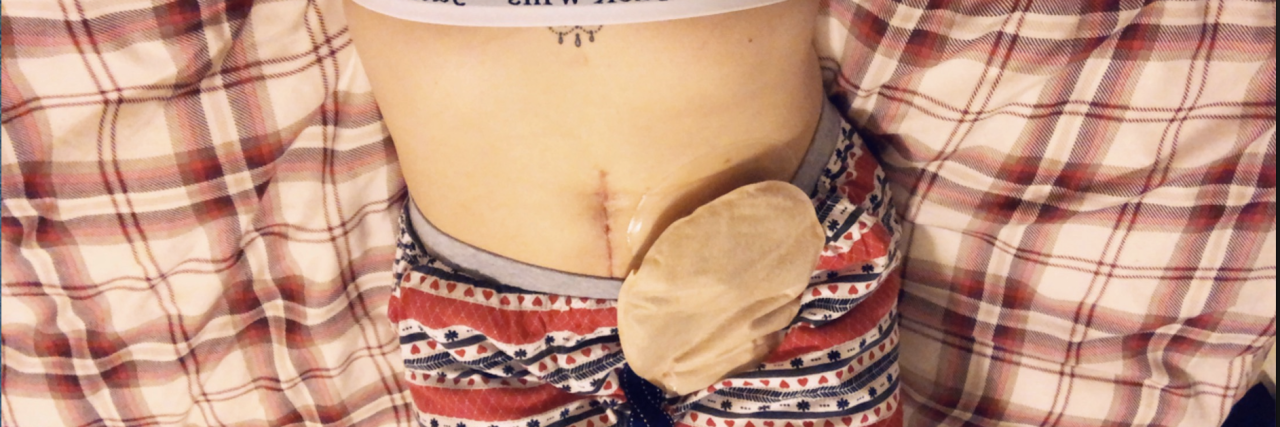 15 Things They Don’t Tell You About Having an Ileostomy Natalie's stoma and bag.
