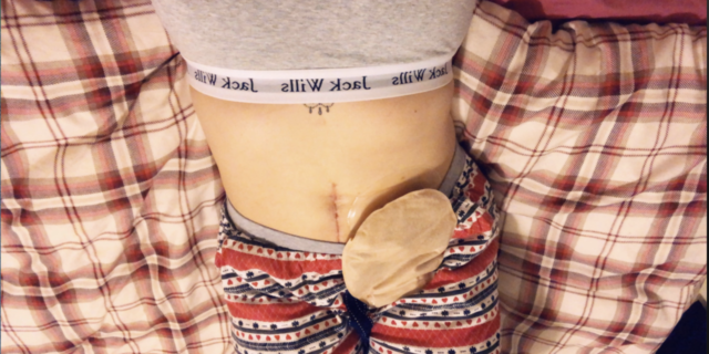 15 Things They Don’t Tell You About Having an Ileostomy Natalie's stoma and bag.