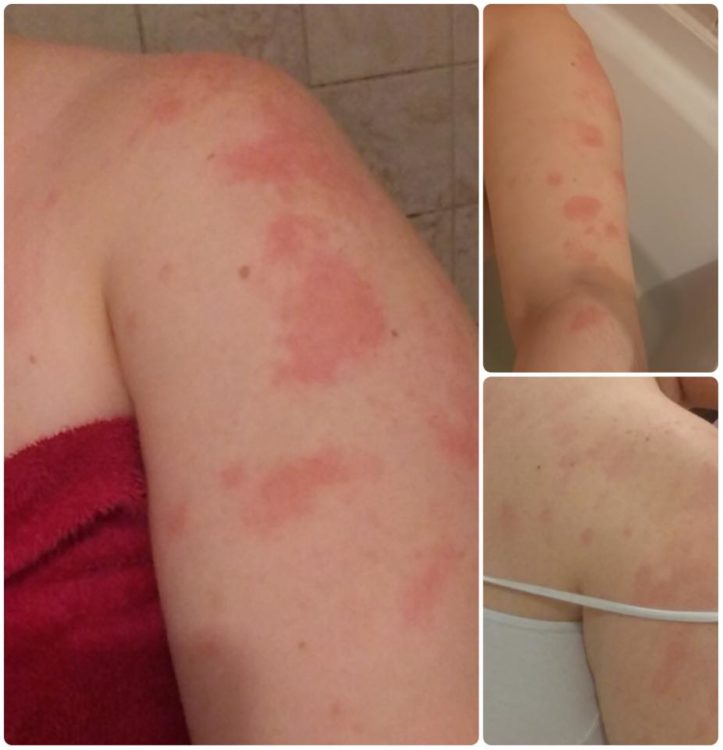 blotches of red marks on skin in multiple photos