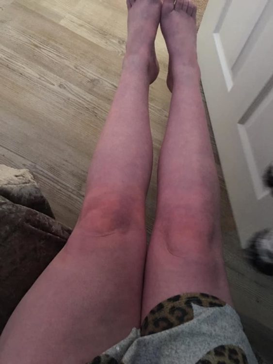 woman's legs side by side different sizes