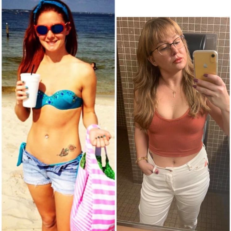 woman in bathing suit before and after after chronic illness caused weight gain