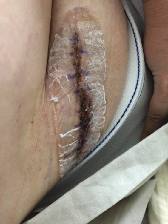 woman's large scar after multiple surgeries