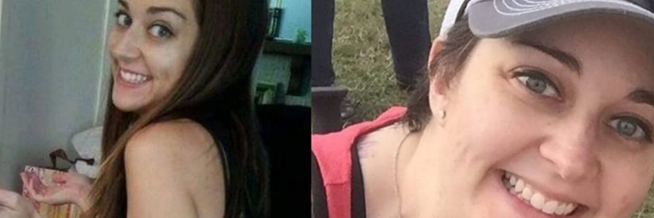 Unexpected Ways Chronic Illness Can Physically Change Your Body unexpected changes with chronic illness before and after photo