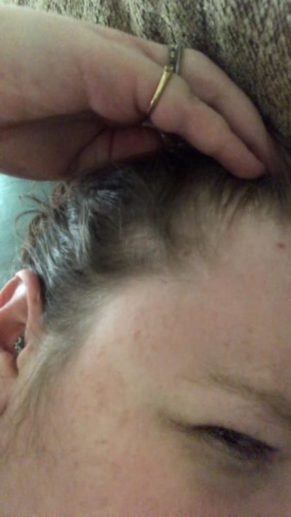 woman thinning hair