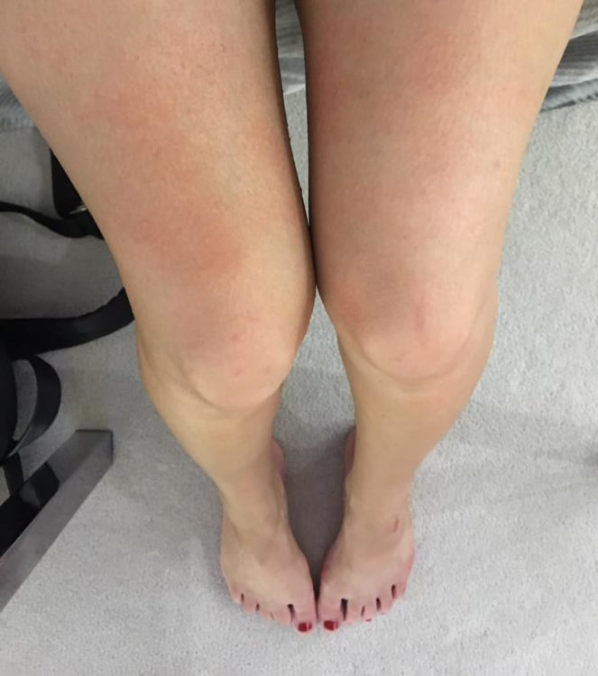 woman legs with rashes