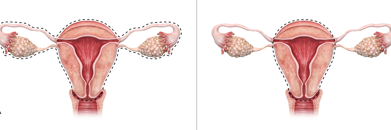 8 Ways I Coped With Having a Hysterectomy at 23