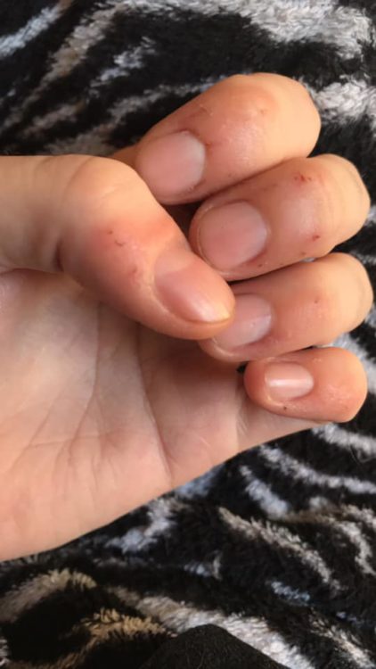 woman with bitten nails