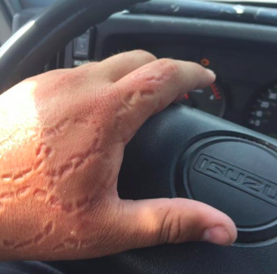 person with bite marks on hand