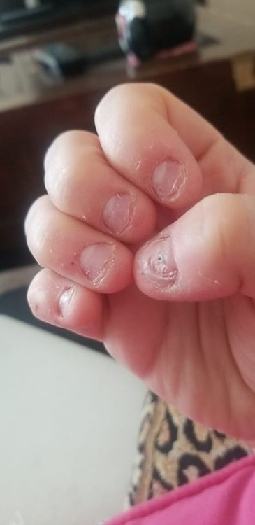 person with bitten down nails