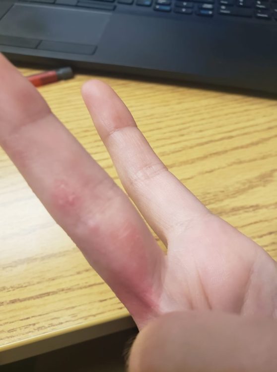 woman with rash on fingers