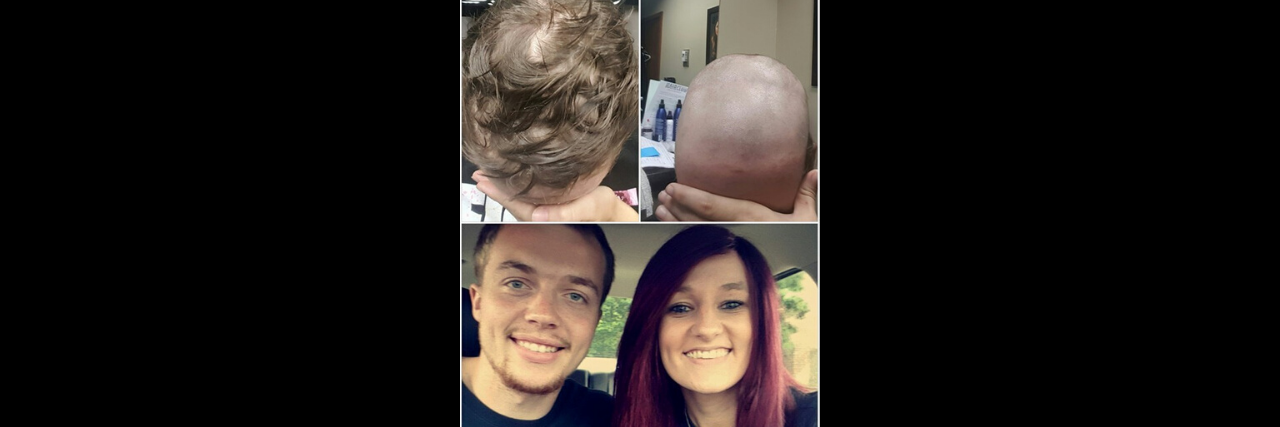 Finding Strength Through Hair Loss From Alopecia A woman with hair loss shows her before and after photos.