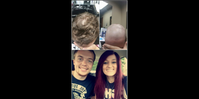 What It S Like Losing Your Hair As A Teenager Due To Alopecia