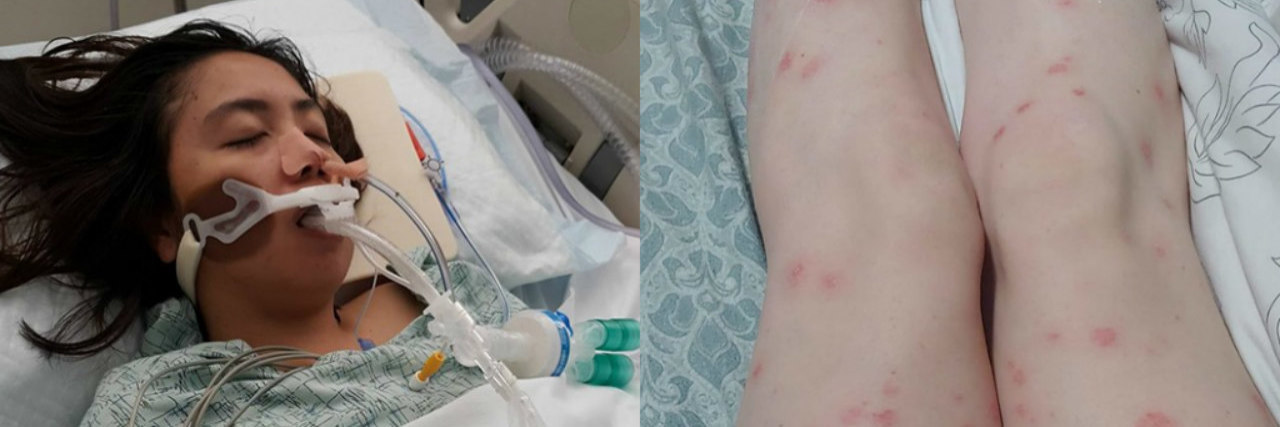 woman in coma side by side image with rash on legs