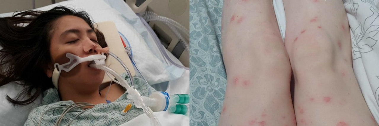 17 Photos of Physical Depression Symptoms woman in coma side by side image with rash on legs