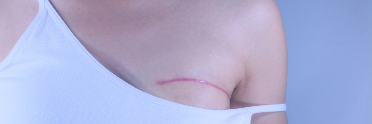 Please Stop Saying a Mastectomy Is a ‘Boob Job’