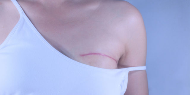 Please Stop Saying a Mastectomy Is a ‘Boob Job’