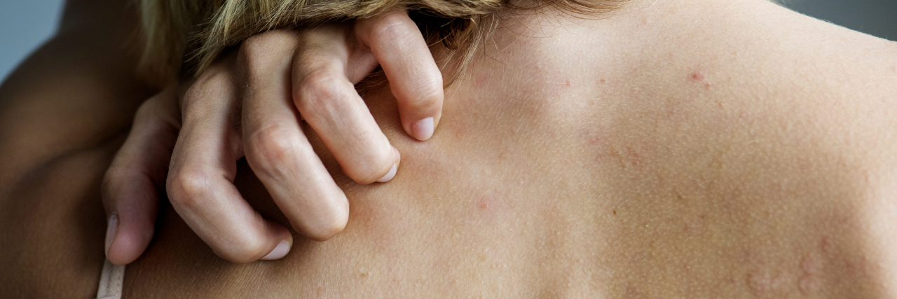 Dystonia Is Not a Country in Eastern Europe the back of a woman with her hands scratching her back