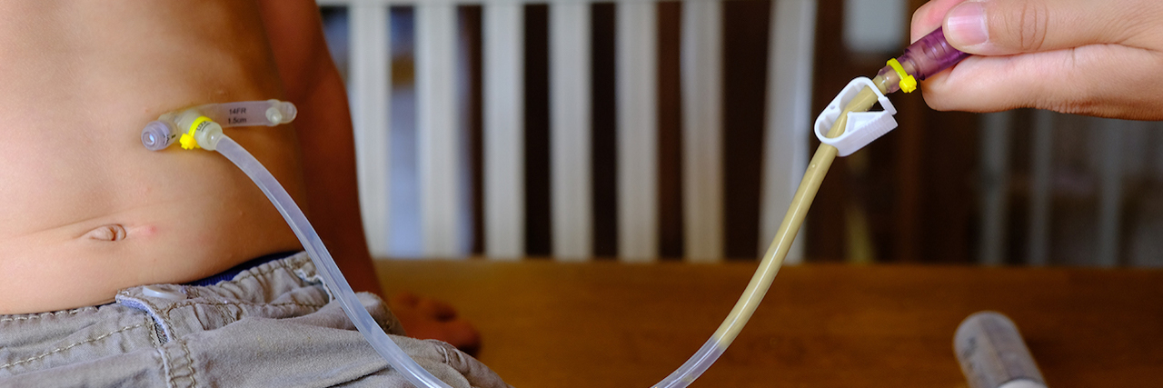 ENFit Connector, Meant to Standardize, Causes Issues for Tube Feeders A new standard for feeding-tube connectors intended to prevent deadly errors in hospitals is causing anger among tube users and advocates for preemie babies. (Courtesy of Rachel Glenn)