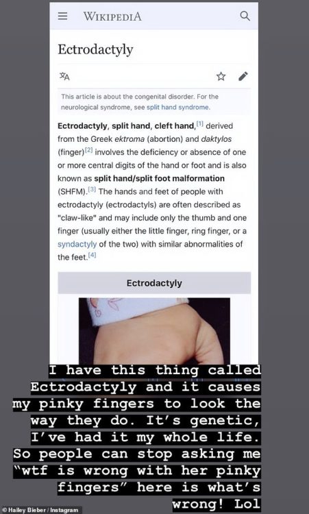 Instagram story with the text "I have this thing called ectrodactyly and it causes my pinky fingers to look the way they do," Bieber wrote. "It's genetic, I've had it my whole life. So people can stop asking me 'wtf is wrong with her pinky fingers' here is what's wrong!"