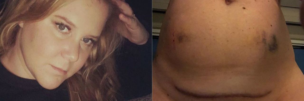 Amy Schumer on the left and a photo of her belly on the right