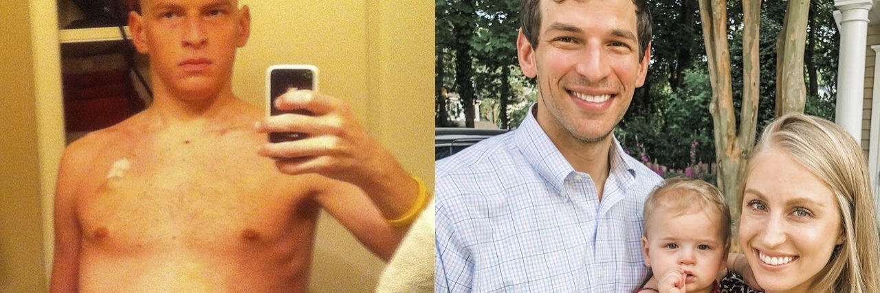 5 Things You Should Know About Castleman Disease A photo David Fajgenbaum, a young looking white man, bald and shirtless with a distended abdomen. Next to that is a photo of David, thin and with hair, standing next to his wife, a young white blonde woman, and their daughter, an infant.