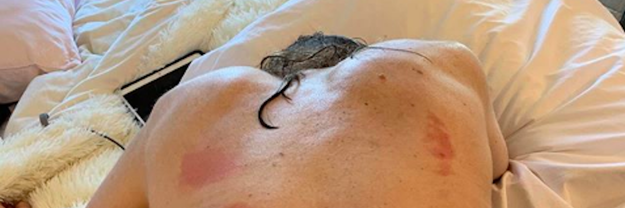 Tatum O'Neal Shares Photo of Her Rheumatoid Arthritis Scars tatum oneal