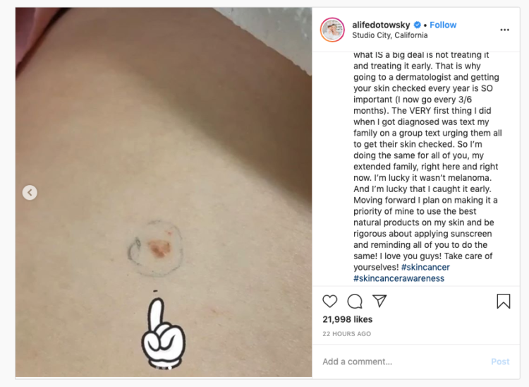 ali fedotowsky skin cancer picture
