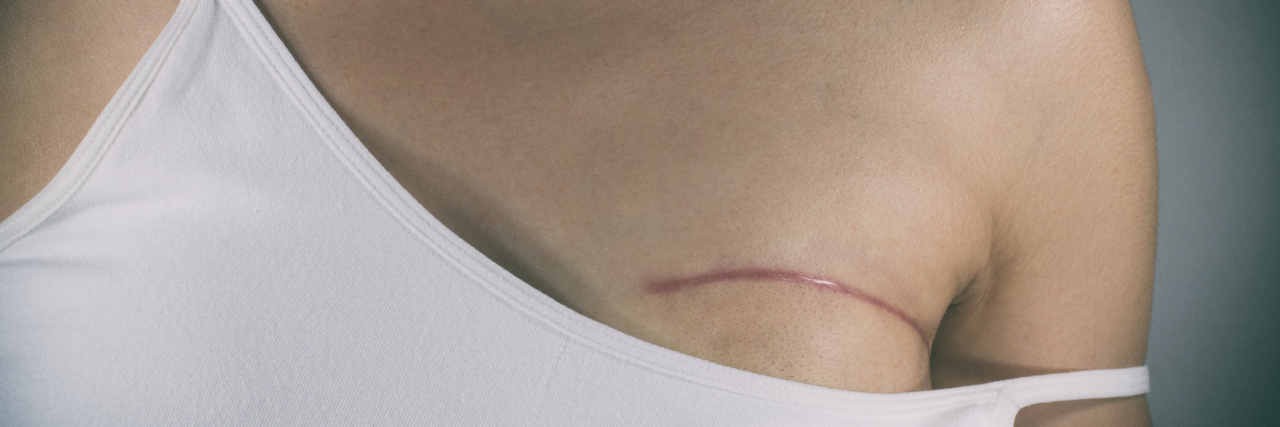 This Is What I See When I Look at My Lumpectomy Scars