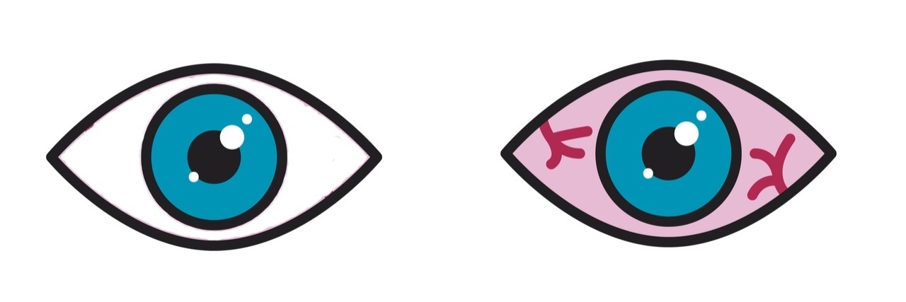 Illustration of two eyes. The one on the left is clear and the one on the right has pink eye
