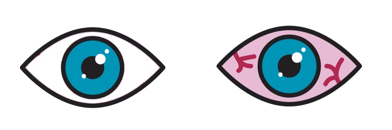 Ophthalmologists Caution Pink Eye a Rare COVID-19 Symptom Illustration of two eyes. The one on the left is clear and the one on the right has pink eye
