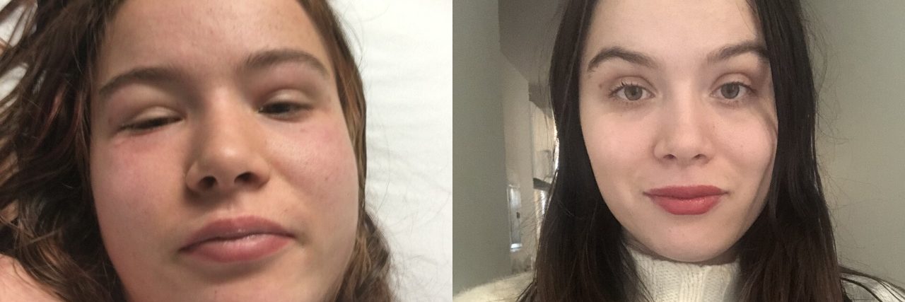 5 Things You Should Know About Vasculitis Julia Métraux