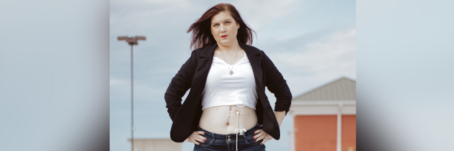 Woman standing proudly and showing off scars on her stomach and feeding tube
