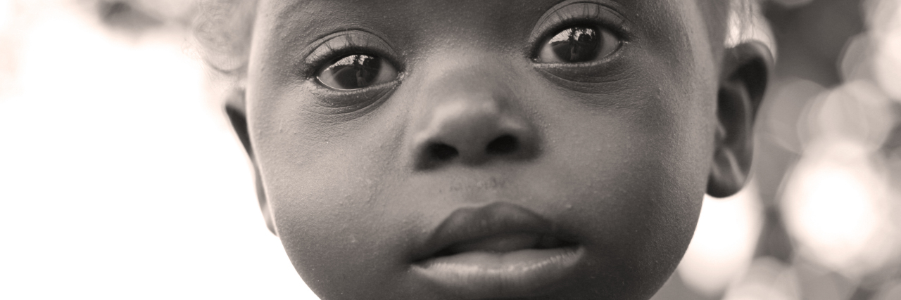 Life Expectancy in Black vs. White Persons With Down Syndrome Black baby with Down syndrome.