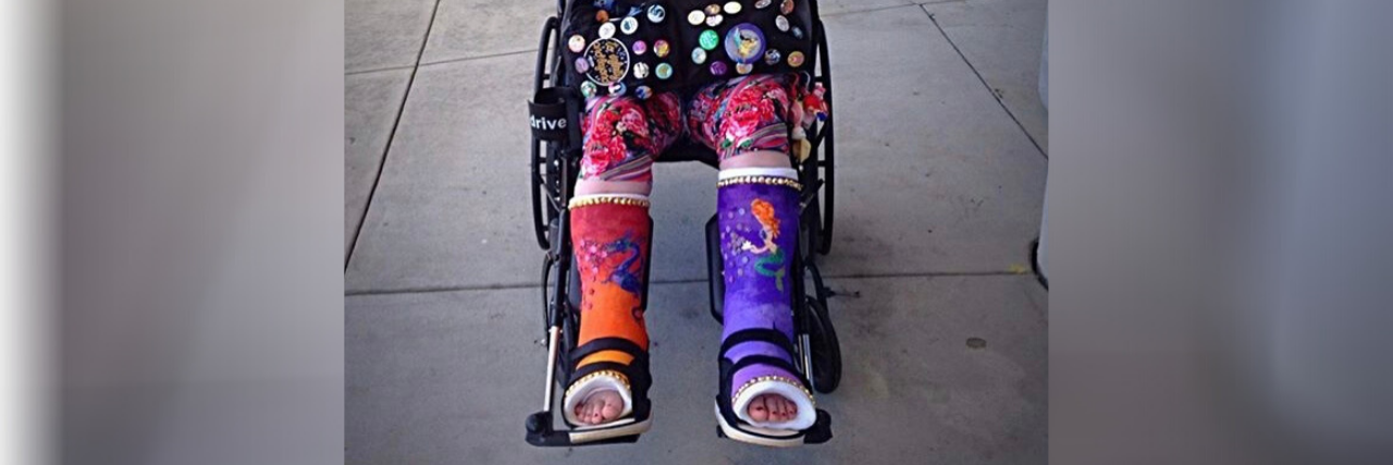 The Power of Painting and Decorating My Osteoporosis Casts Katie wearing two painted leg casts.