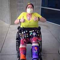 Katie wearing two painted leg casts.