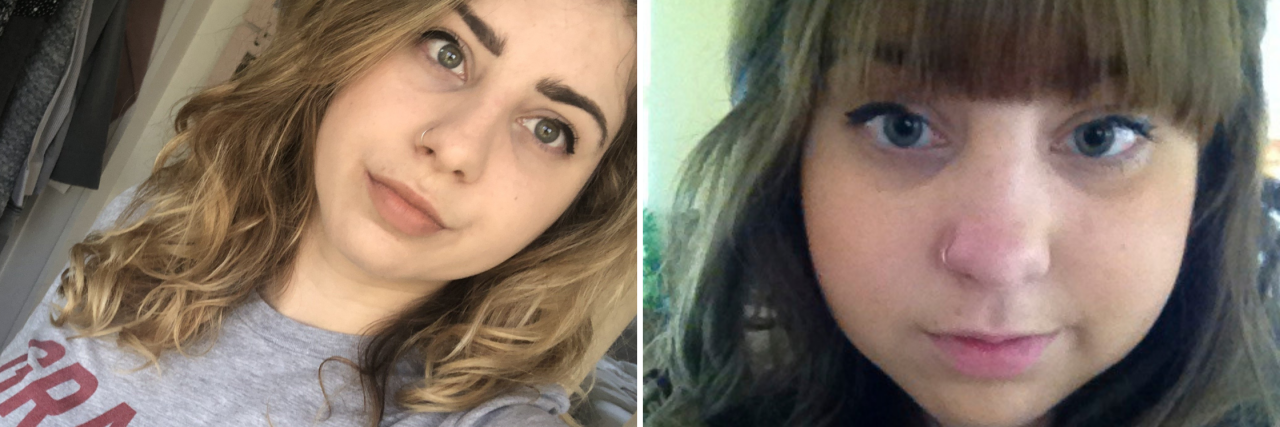 6 Months Off Prednisolone: To the Girl With the Moon Face Diptych of a girl with moon face