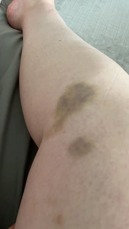 Bruises are visible on a person's leg