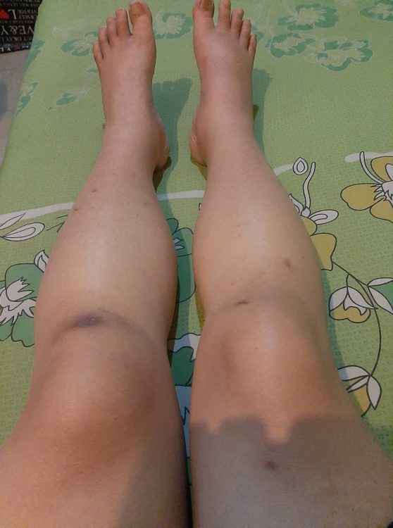 Swollen legs with bruises and cuts on them