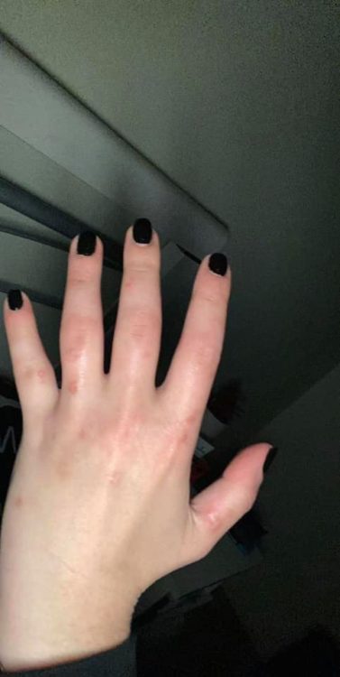 A swollen hand with black nail polish on the fingers