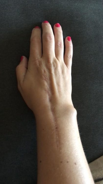 A woman's fused wrist is visible in this photo