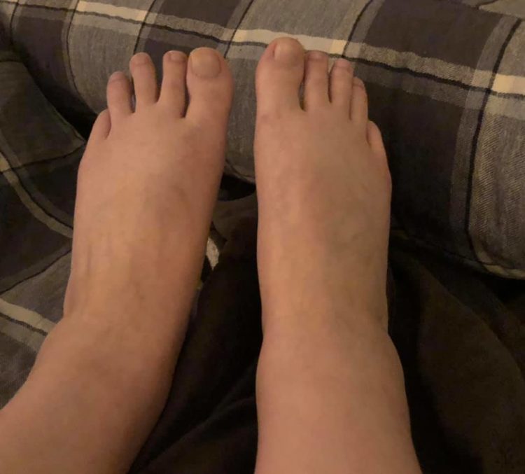 A photo of two sollen ankles